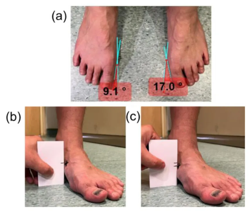 Bunion angle measurement techniques and severity classification