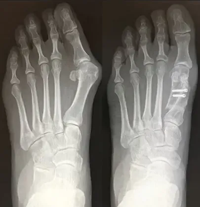 X-ray comparison showing bunion progression and angle measurements