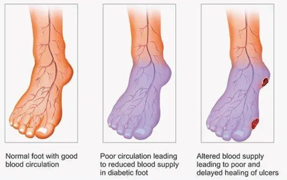 Circulation problems and peripheral vascular disease warnings