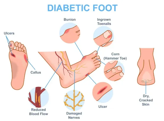 Diabetes foot care warnings and safety guidelines