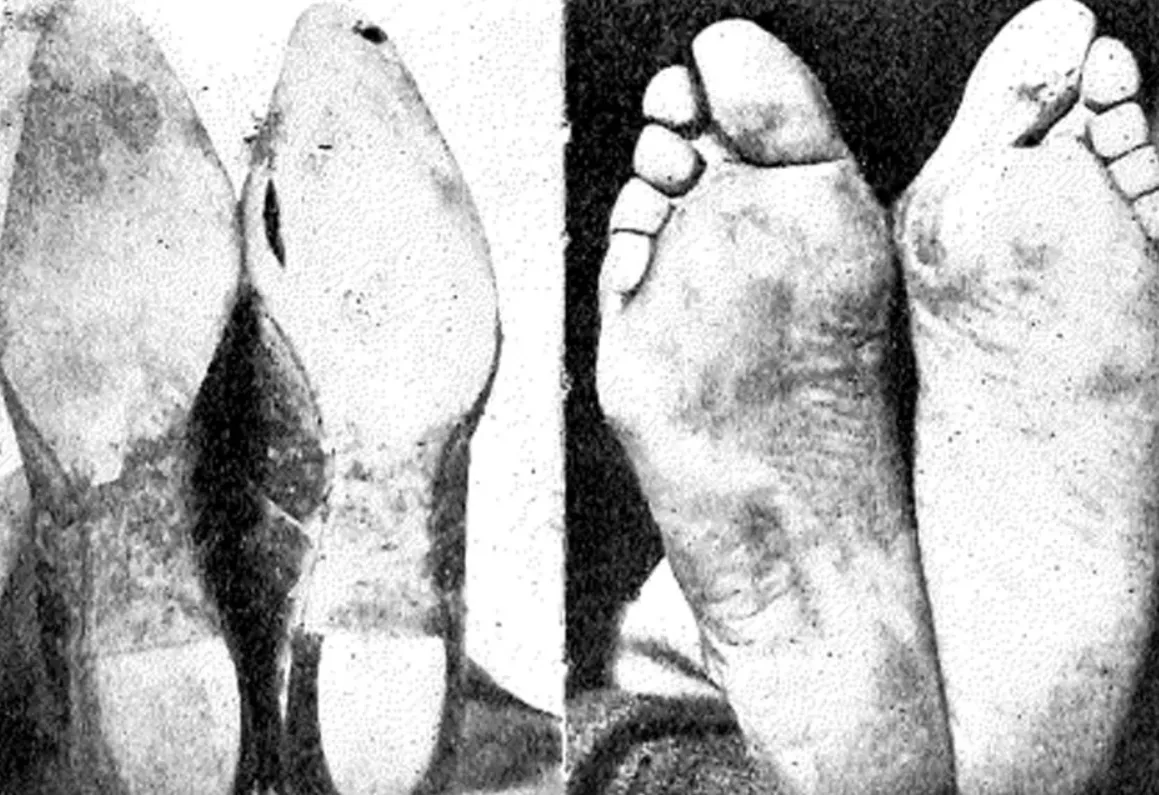 Natural foot anatomy vs. shoe-shaped deformation