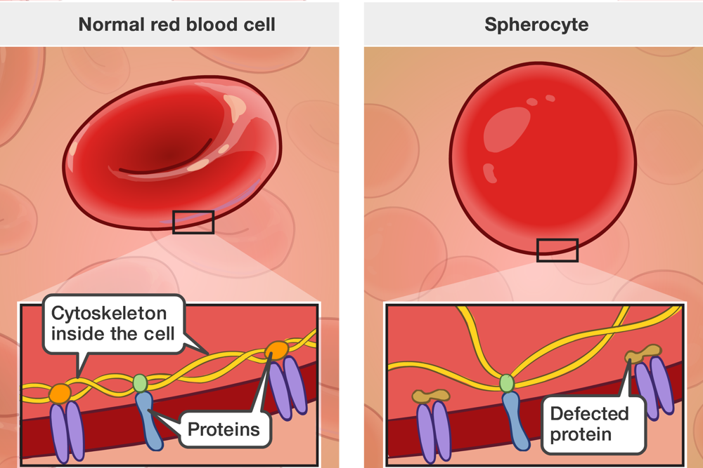 EFFECTIVE DIAGNOSTIC APPROACHES FOR HEREDITARY SPHEROCYTOSIS AND G6PD DEFICIENCY