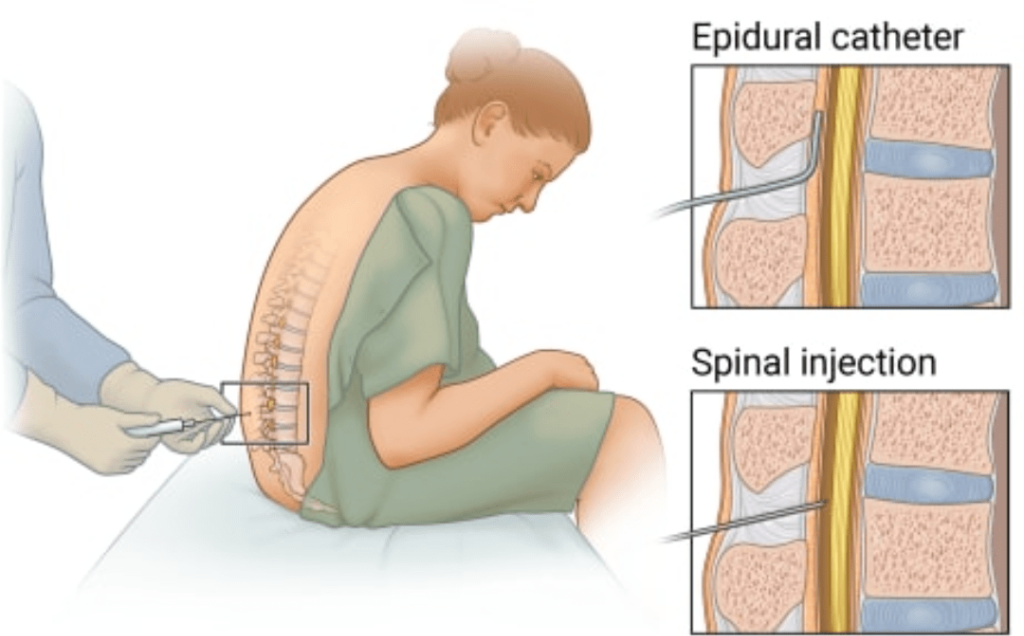 THE PERILS OF EPIDURAL CATHETER MIGRATION: UNDERSTANDING CAUSES, CONSEQUENCES, AND PREVENTION