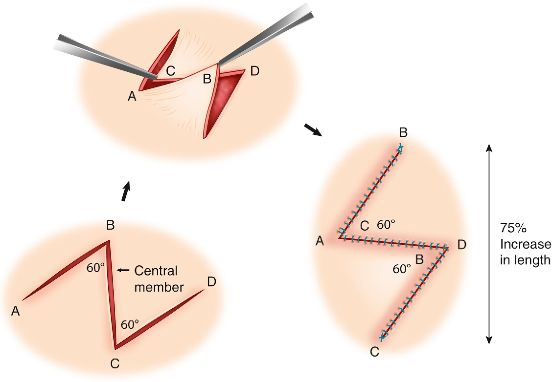 THE Z-PLASTY: PRINCIPLES, TECHNIQUE, AND APPLICATION IN CUTANEOUS RECONSTRUCTION