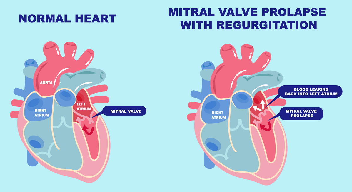 THE COMPLETE CLINICAL OVERVIEW OF MITRAL VALVE PROLAPSE | MY SCHOOL EXAMS