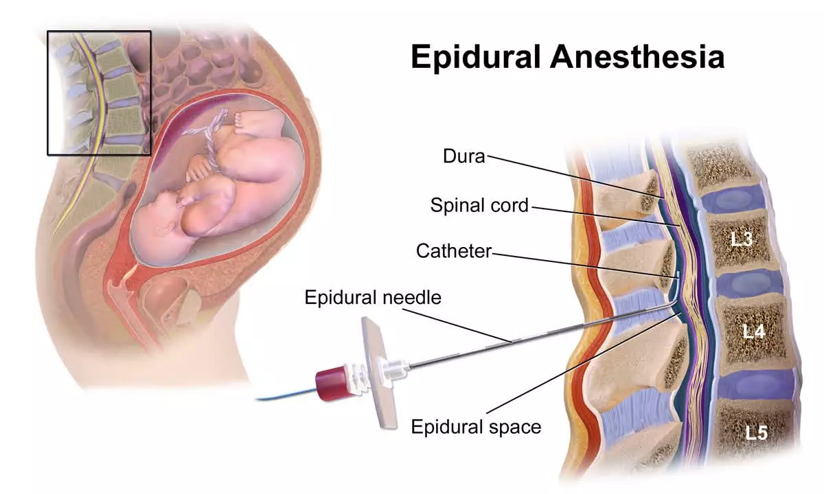 UNDERSTANDING AND MANAGING INADEQUATE EPIDURAL ACTIVATION OR MAINTENANCE DOSE FOR LABOUR