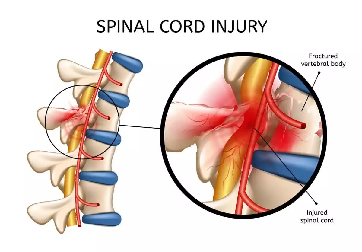 DIAGNOSIS AND MANAGEMENT OF SPINAL CORD INJURY: WHAT YOU SHOULD KNOW
