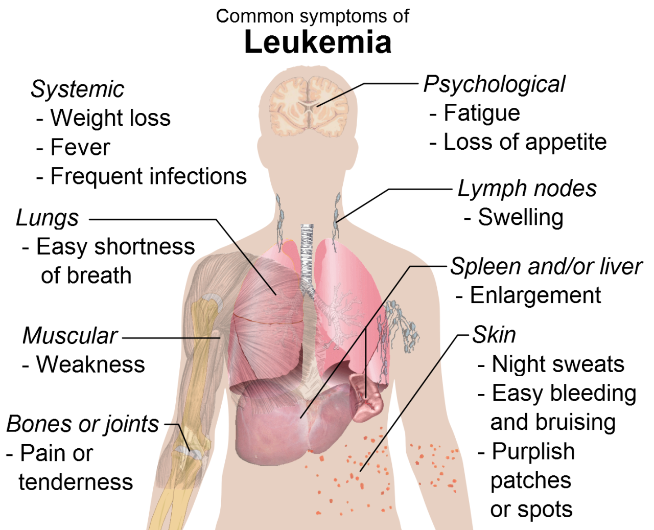 Symptoms_of_leukemia