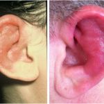 A COMPREHENSIVE GUIDE TO RELAPSING POLYCHONDRITIS: UNDERSTANDING ITS PATHOGENESIS AND PROGNOSIS