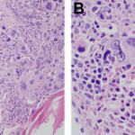 COMPREHENSIVE APPROACH TO MYELOPHTHISIC ANEMIA: ETIOLOGY, DIAGNOSIS, MANAGEMENT