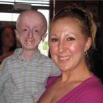 MANAGING PROGERIA: AN IN-DEPTH LOOK AT PATHOPHYSIOLOGY, EARLY DIAGNOSIS, AND EFFECTIVE TREATMENT PLANS