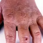 COMPREHENSIVE UNDERSTANDING OF ERYTHROPOIETIC PROTOPORPHYRIA AND X-LINKED PROTOPORPHYRIA