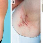 UNDERSTANDING HIDRADENITIS SUPPURATIVA: PATHOPHYSIOLOGY AND CLINICAL MANIFESTATIONS