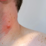 ESSENTIAL INSIGHTS INTO ATYPICAL FIBROXANTHOMA: THE COMPLETE MANUAL