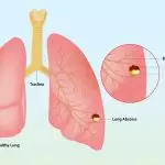 LUNG ABSCESS: EVERYTHING YOU NEED TO KNOW ABOUT THIS PULMONARY CONDITION