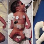 ALL YOU NEED TO KNOW ABOUT ARTHROGRYPOSIS MULTIPLEX CONGENITA: DIAGNOSIS AND MANAGEMENT