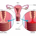 EXPERT INSIGHTS ON CERVICITIS: ETIOLOGY, ACCURATE DIAGNOSIS, AND BEST MANAGEMENT PRACTICES