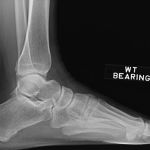 UNDERSTANDING AND TREATING ACHILLES TENDON ENTHESOPATHY