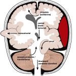 CLINICAL INSIGHTS INTO BRAIN HERNIATION: AN IN-DEPTH ANALYSIS