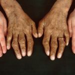 A COMPREHENSIVE OVERVIEW OF HEREDITARY HEMOCHROMATOSIS: FROM ETIOLOGY TO TREATMENT