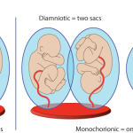 MULTIFETAL GESTATION: ESSENTIAL INFORMATION FOR EXPECTING PARENTS