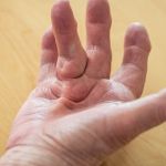YOUR ESSENTIAL GUIDE TO DUPUYTREN’S CONTRACTURE: FROM DIAGNOSIS TO TREATMENT OPTIONS