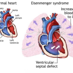 A CLOSER LOOK AT EISENMENGER SYNDROME: FROM DIAGNOSIS TO MANAGEMENT