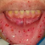 HEREDITARY HEMORRHAGIC TELANGIECTASIA EXPLAINED