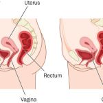 DIAGNOSIS AND EFFECTIVE MANAGEMENT STRATEGIES FOR ANTERIOR AND POSTERIOR VAGINAL WALL PROLAPSE