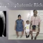 A THOROUGH GUIDE TO HYPOPHOSPHATEMIC RICKETS: FROM EARLY SIGNS TO ADVANCED THERAPIES