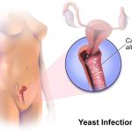 CANDIDAL VAGINITIS IN FOCUS: EXPLORING PATHOPHYSIOLOGY, DIAGNOSTIC APPROACHES, AND MANAGEMENT