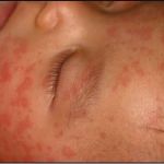 EXPLORING THE COMPLEX PATHOPHYSIOLOGY OF CRYOPYRIN-ASSOCIATED PERIODIC SYNDROMES