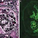 A COMPLETE OVERVIEW OF ANTI-GLOMERULAR BASEMENT MEMBRANE DISEASE