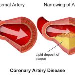TOP STRATEGIES FOR MANAGING CORONARY ATHEROSCLEROSIS EFFECTIVELY