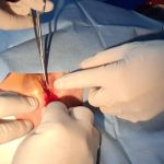 HOW TO PERFORM A LATERAL CANTHOTOMY: ESSENTIAL STEPS FOR OCULAR EMERGENCIES