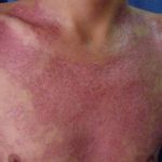 NAVIGATING LANGERHANS CELL HISTIOCYTOSIS: WHAT YOU NEED TO KNOW