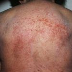 HYPEREOSINOPHILIC SYNDROME: ESSENTIAL INSIGHTS FOR CLINICIANS