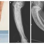 CLINICAL INSIGHTS INTO PAGET DISEASE OF BONE: A THOROUGH GUIDE