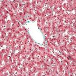 EVERYTHING YOU NEED TO KNOW ABOUT CONGESTIVE HEPATOPATHY