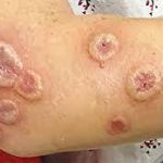 ACUTE FEBRILE NEUTROPHILIC DERMATOSIS EXPLAINED: KEY INSIGHTS AND MANAGEMENT