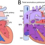 EVERYTHING YOU NEED TO KNOW ABOUT TOTAL ANOMALOUS PULMONARY VENOUS RETURN IN CHILDREN