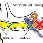 EFFECTIVE APPROACHES TO MANAGING SENSORINEURAL HEARING LOSS IN PATIENTS