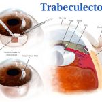 OBSERVING GLAUCOMA FILTRATION SURGERY: EDUCATIONAL GUIDE TO TRABECULECTOMY