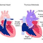 PERSISTENT TRUNCUS ARTERIOSUS EXPLAINED: DIAGNOSIS, TREATMENT, AND MANAGEMENT