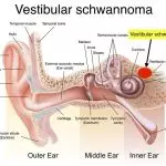 CLINICAL PRESENTATION OF VESTIBULAR SCHWANNOMA: A DETAILED OVERVIEW