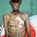 CANCER CACHEXIA EXPLAINED: KEY INSIGHTS INTO PATHOPHYSIOLOGY AND MANAGEMENT