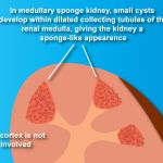 COMPREHENSIVE PATHOPHYSIOLOGY AND TREATMENT GUIDE FOR MEDULLARY SPONGE KIDNEY