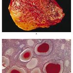 PELIOSIS HEPATIS: UNRAVELING A RARE AND CHALLENGING LIVER CONDITION