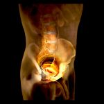 ARGININE VASOPRESSIN RESISTANCE EXPLAINED: A COMPLETE CLINICAL OVERVIEW