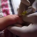 IN-DEPTH CLINICAL GUIDE TO UNDERSTANDING PERINATAL POLYCYTHEMIA AND HYPERVISCOSITY SYNDROME